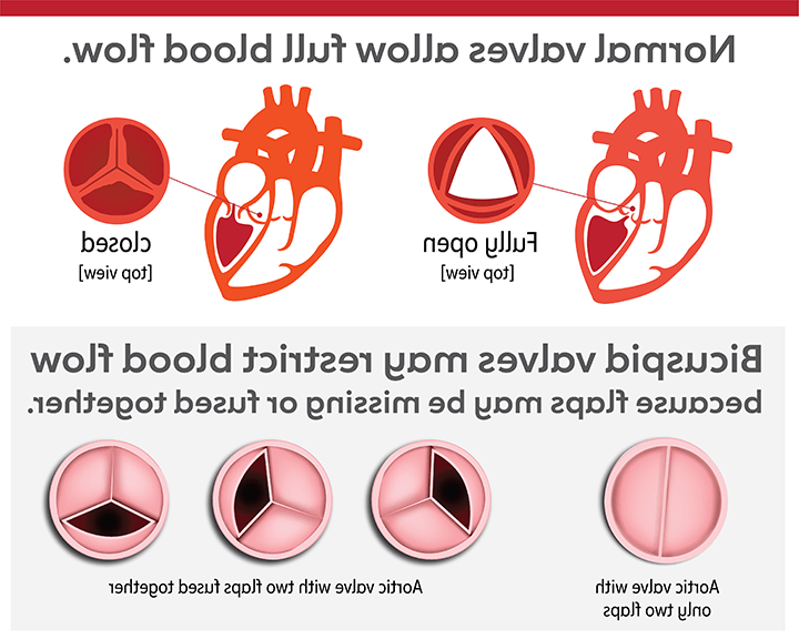 bicuspid valves may restrict blood flow